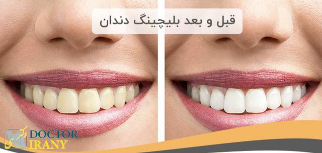 بلیچینگ دندان چیست