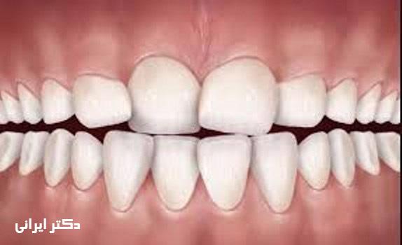 دلایل شل یا کج شدن دندان به مرور زمان